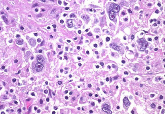 Neoplasie ematologiche e predisposizione familiare